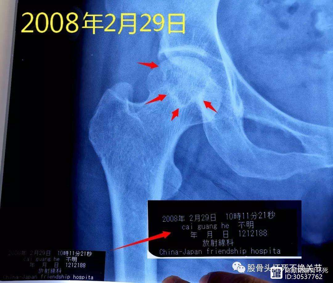 鄂尔多斯人工骨头医保报销多少(人工骨头医保报销多少比例)